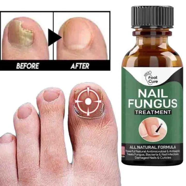 Fast Nail Fungus Treatment Serum – Nail Repair